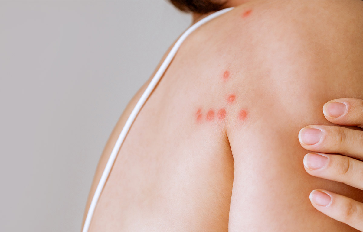 what causes bed bugs