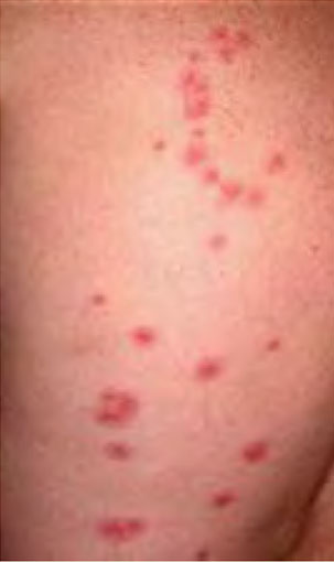 bed-bug-bit-symptoms