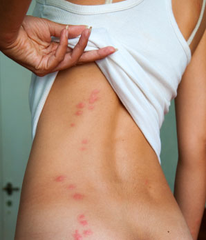 what-causes-bed-bug