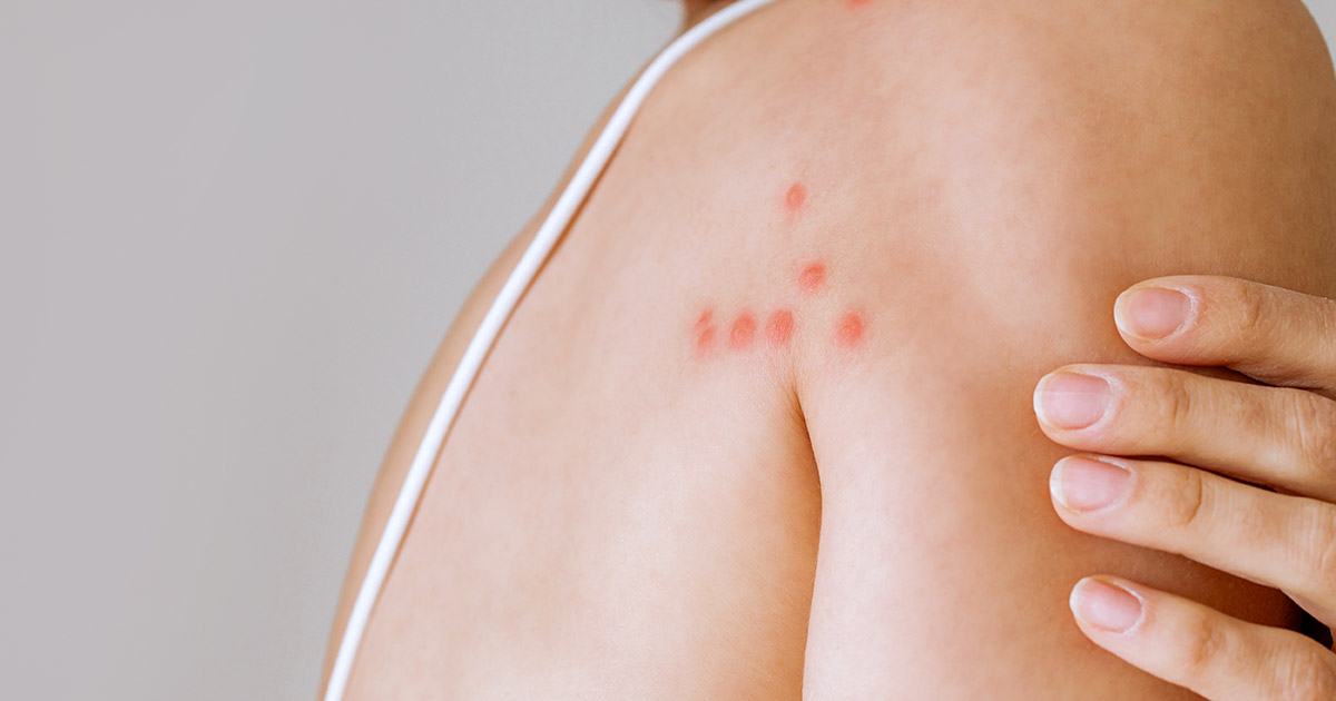 Bed bug bites