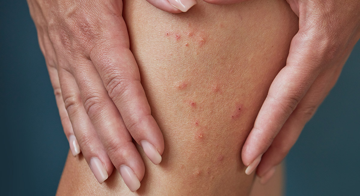 flea bites