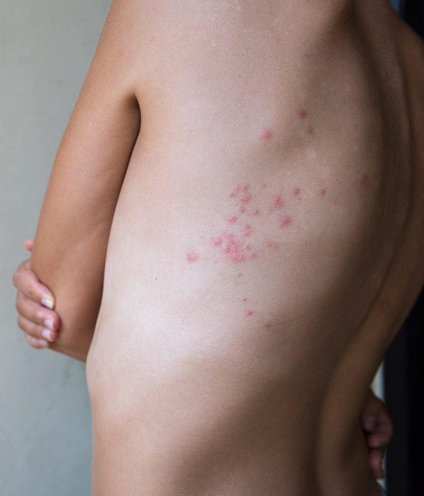 Bed Bug Bite Symptoms Toronto