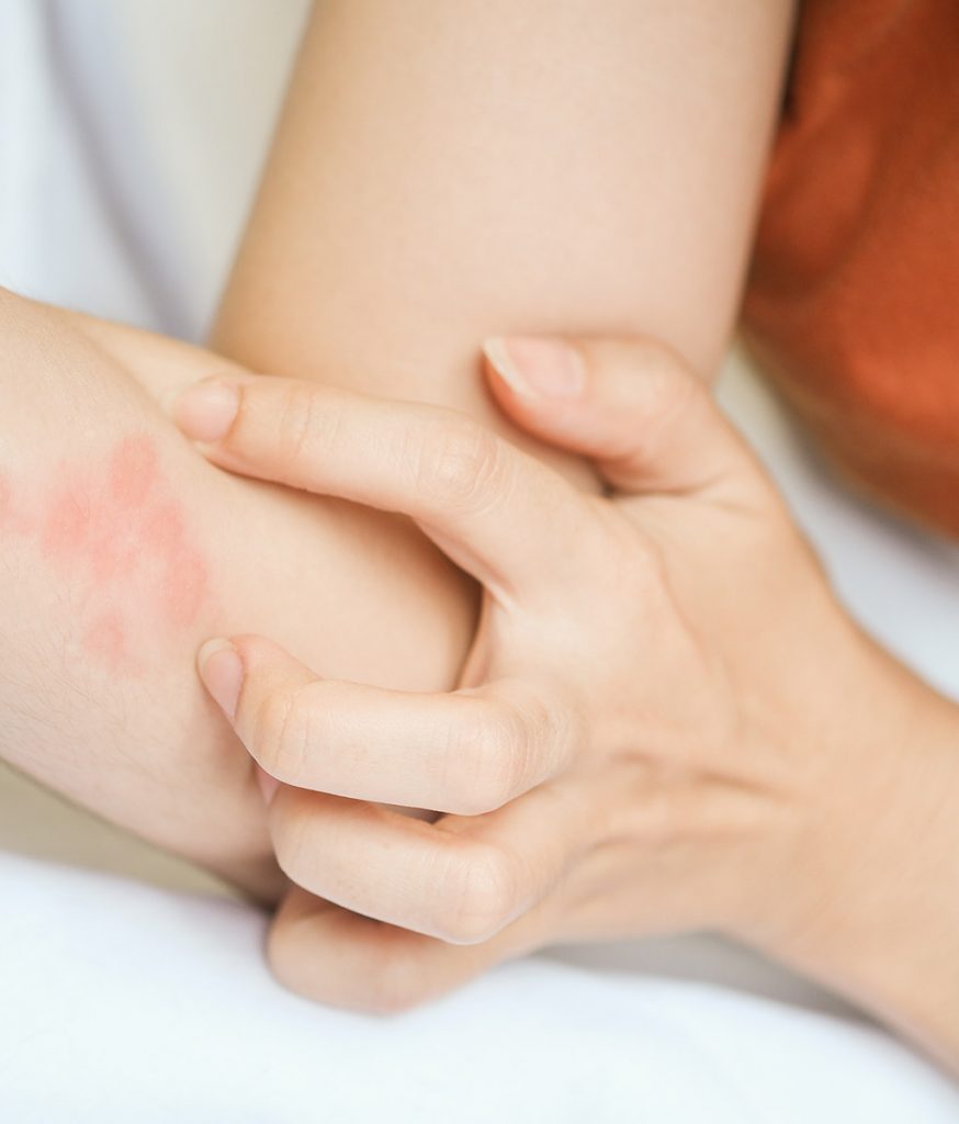 How Long Do Bed Bug Bites Last