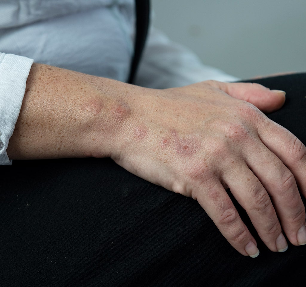 Reactions to Bed Bug Bites Toronto