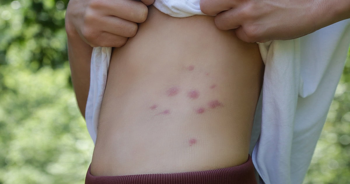Bed Bugs Bites That Appear in a Line or Cluster