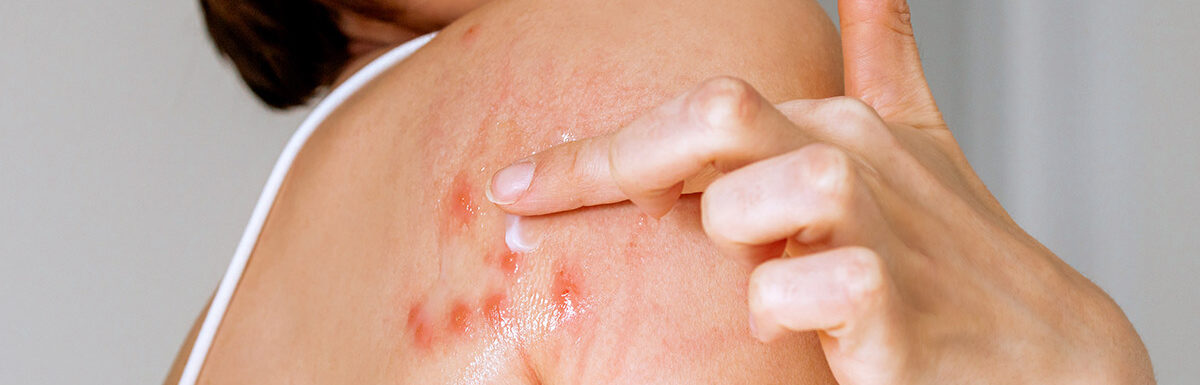 How Long Do Bed Bug Bites Last